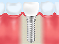 インプラント治療